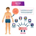 Hives urticaria vector illustration. Labeled skin rash explanation scheme.