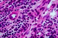 Hodgkin`s lymphoma, light micrograph Royalty Free Stock Photo