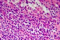 Hodgkin's lymphoma, light micrograph Royalty Free Stock Photo