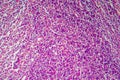 Hodgkin's lymphoma, light micrograph Royalty Free Stock Photo