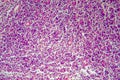 Hodgkin's lymphoma, light micrograph Royalty Free Stock Photo