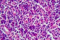 Hodgkin's lymphoma, light micrograph Royalty Free Stock Photo