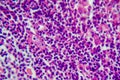 Hodgkin's lymphoma, light micrograph Royalty Free Stock Photo