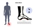 Hollow feet anatomy Royalty Free Stock Photo