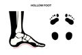 Hollow feet anatomy