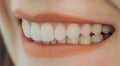 Hollywood smile with porcelain crowns and veneers Royalty Free Stock Photo