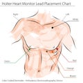 Holter Heart Monitor Lead Placement Chart