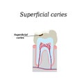 Home tooth caries. Vector illustration on Royalty Free Stock Photo