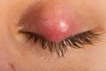 Hordeolum on upper eyelid. Viral infection