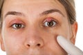 Hordeolum on upper eyelid. Viral infection Royalty Free Stock Photo