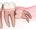 Horizontal impaction of Wisdom tooth. Medically accurate tooth 3D illustration Royalty Free Stock Photo