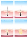 How acne happens. acne stages,
