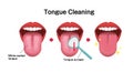 How to clean your tongue vector illustration Halitosis prevention