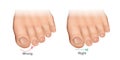 How to cut toenails correctly vector illustration. Proper and improper trimming of nails.Ingrown Toenails.