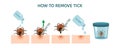How to remove tick steps Infographic banner. Instruction to prevent Lyme or borreliosis disease because of mite bite