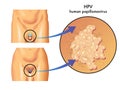 HPV (human papillomavirus) Royalty Free Stock Photo