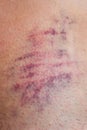 Huge bruise on the body. Close-up - wounded leg with bruise and abrasion. Injured skin. Household injuries, harm to health Royalty Free Stock Photo