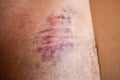 Huge bruise on the body. Close-up - wounded leg with bruise and abrasion. Injured skin. Household injuries, harm to health Royalty Free Stock Photo