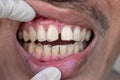 Huge gap between the front teeth or incisors. Diastema. Cracked or chipped teeth Royalty Free Stock Photo