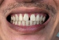 Huge gap between the front teeth or incisors. Diastema Royalty Free Stock Photo