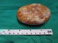 Laminated Urinary Bladder Stone extracted via Open Vesicolithotomy Royalty Free Stock Photo
