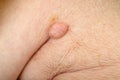 Huge wart on human skin Royalty Free Stock Photo