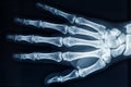 Human adult right hand bones x-ray image. Medical and anatomy radiography or imagery