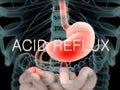 Human anatomy xray-like view of abdomen and intestines showing acid reflux. Royalty Free Stock Photo