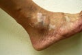 Human ankle, with condition vitiligo. Royalty Free Stock Photo