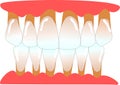 Human anterior teeth with periodontitis