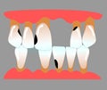 Human anterior teeth with teeth space periodontitis and caries