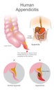 Human Appendicitis. A blocked by a piece of stool thereby blocking it is contents from emptying into intestines. Large Intestine