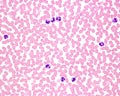 Human blood smear. Leukocytosis