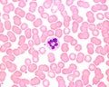 Human blood smear. Neutrophil hypersegmentation