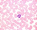 Human blood smear. Neutrophil hypersegmentation