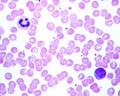 Human blood smear. Neutrophil and lymphocyte