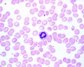 Human blood smear. Ring neutrophil. Infectious mononucleosis