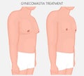 Human body anatomy_Gynecomastia treatment