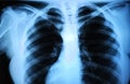 Human body's radiograph - lung