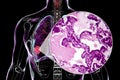 Lung cancer, 3D illustration and light micrograph