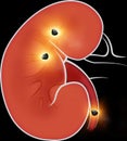 Human body view of kidneys. Section of the kidney. Kidney stones