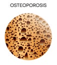 Human bone disease- osteoporosis Royalty Free Stock Photo