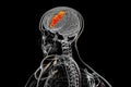 Human brain in the body with highlighted middle frontal gyrus