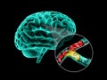 Human brain with cerebral sclerosis. Human brain anatomy 3d illustration.