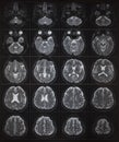 Human brain MRI on light box Royalty Free Stock Photo