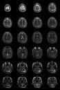 Human brain on MRI scans