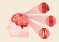 Human brain stroke illustration