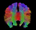 Human brain white matter corpus callosum