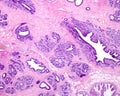 Human breast adenosis