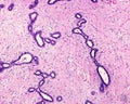 Human breast gland. Adenosis. Excretory ducts